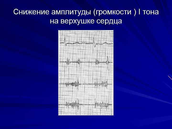 Снижение амплитуды (громкости ) I тона на верхушке сердца 