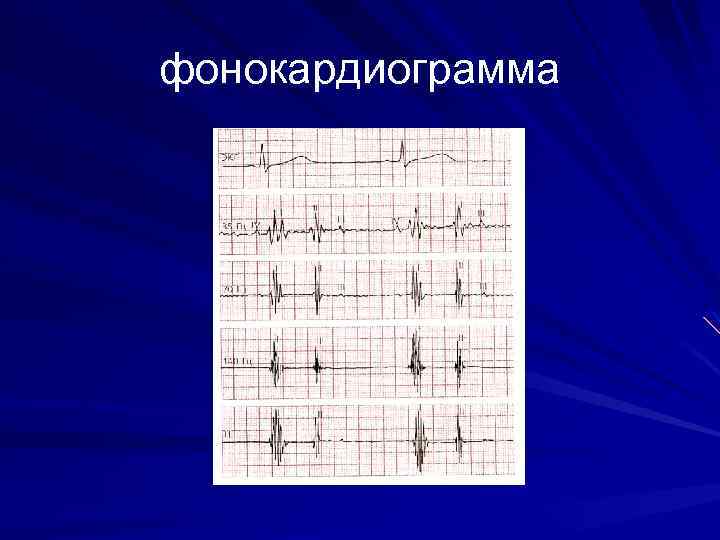 фонокардиограмма 