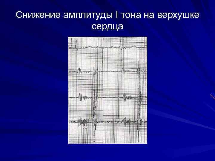 Снижение амплитуды I тона на верхушке сердца 