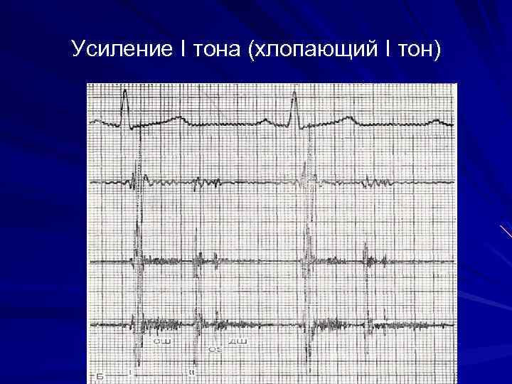 Усиление I тона (хлопающий I тон) 