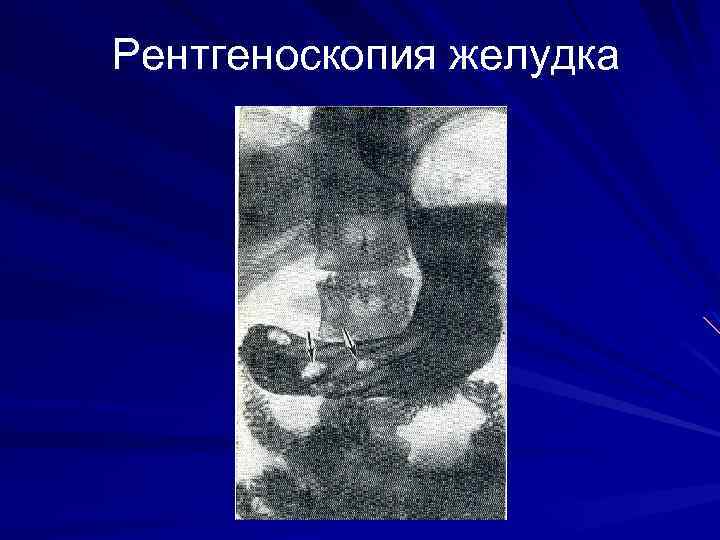 Рентгеноскопия желудка 