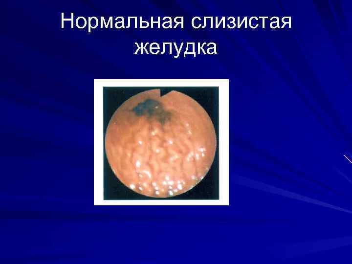 Нормальная слизистая желудка 