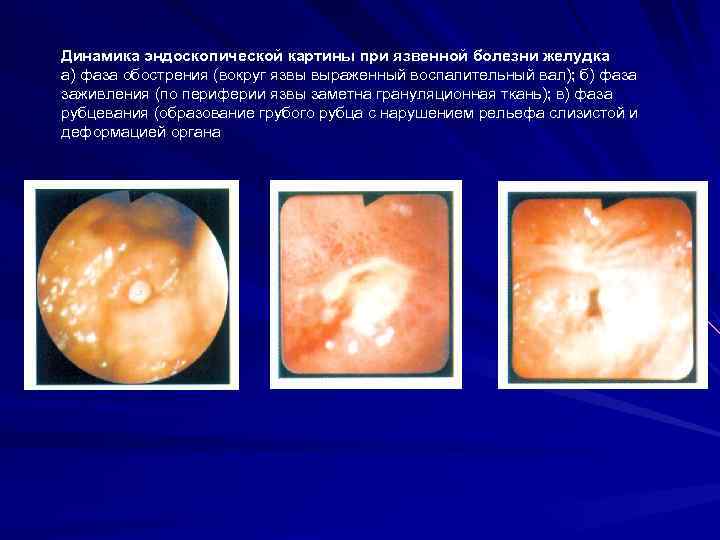 Динамика эндоскопической картины при язвенной болезни желудка а) фаза обострения (вокруг язвы выраженный воспалительный