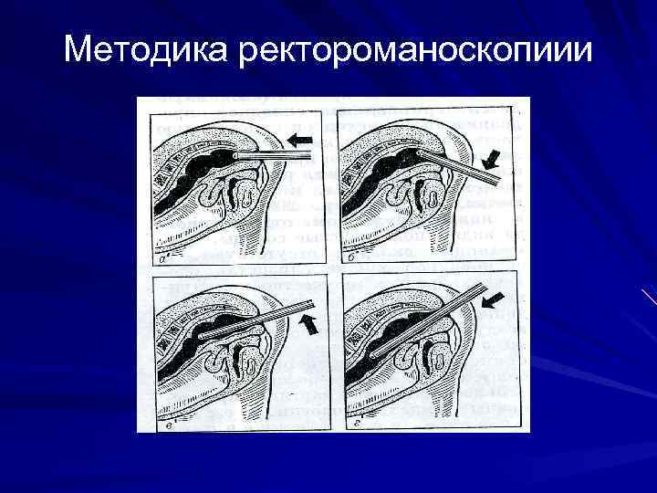 Методика ректороманоскопиии 