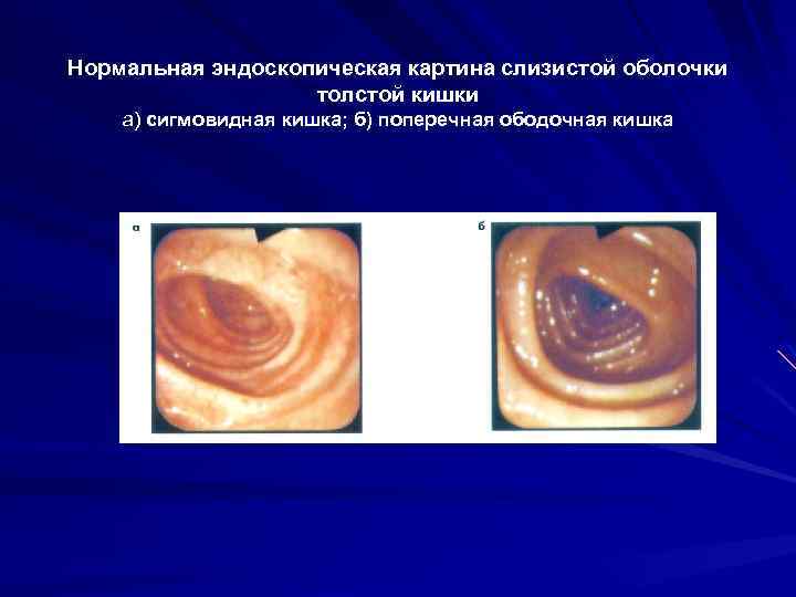 Нормальная эндоскопическая картина слизистой оболочки толстой кишки а) сигмовидная кишка; б) поперечная ободочная кишка