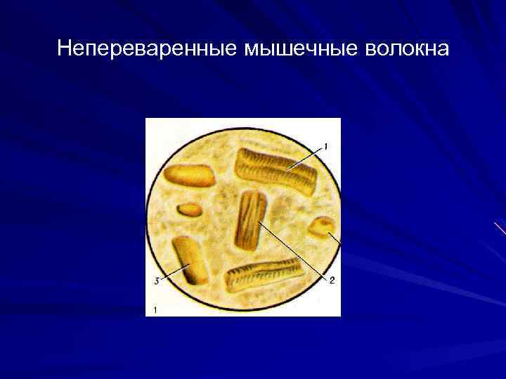 Непереваренные мышечные волокна 