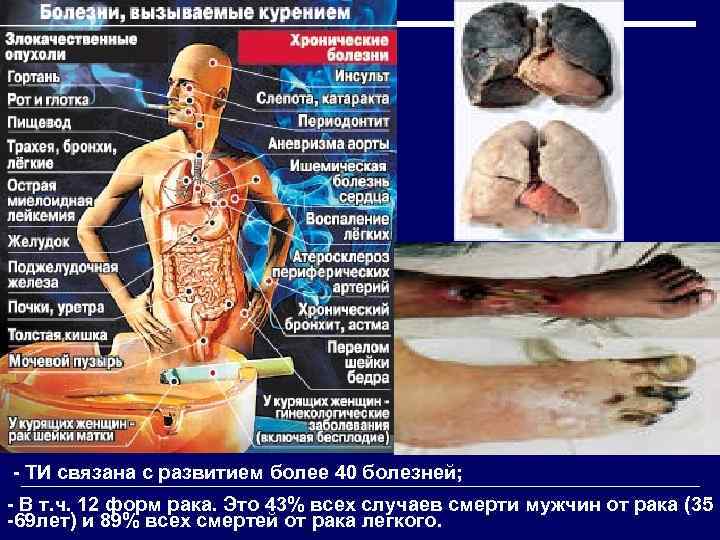  - ТИ связана с развитием более 40 болезней; - В т. ч. 12