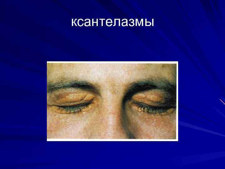 ксантелазмы 