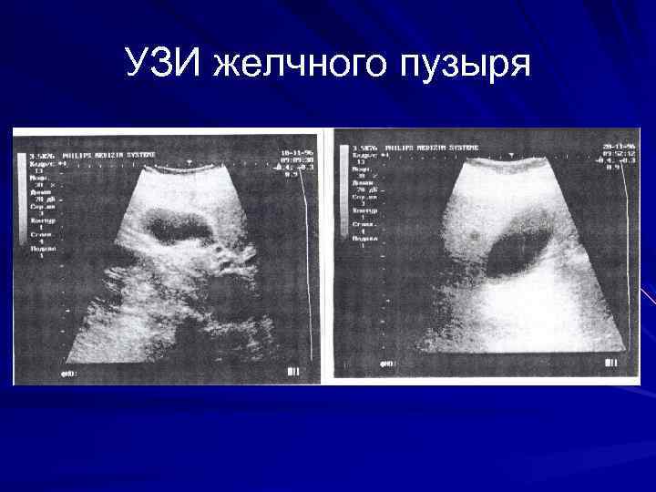 УЗИ желчного пузыря 