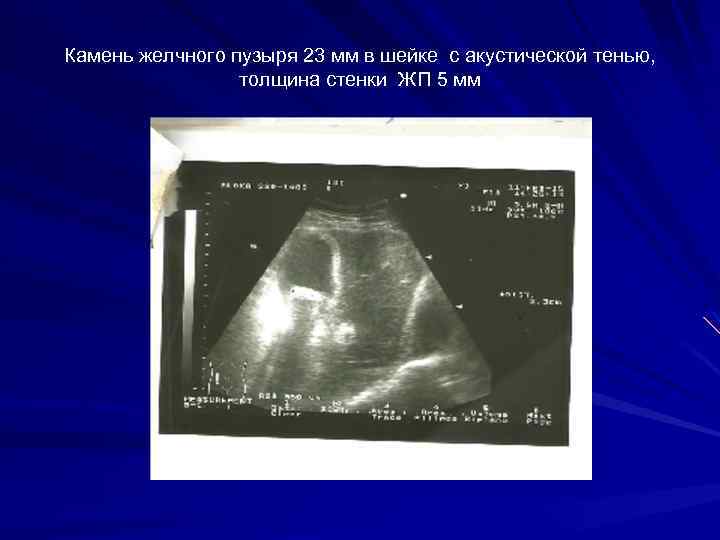 Камень желчного пузыря 23 мм в шейке с акустической тенью, толщина стенки ЖП 5