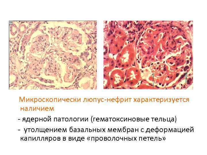 Микроскопически люпус-нефрит характеризуется наличием - ядерной патологии (гематоксиновые тельца) - утолщением базальных мембран с