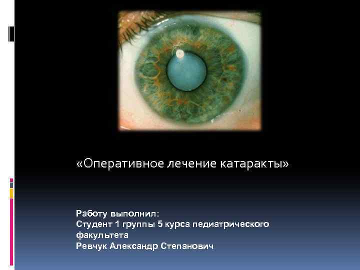  «Оперативное лечение катаракты» Работу выполнил: Студент 1 группы 5 курса педиатрического факультета Ревчук