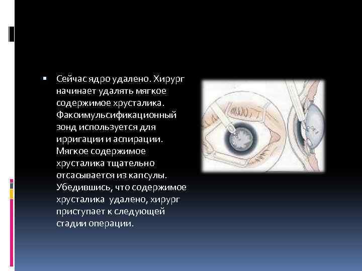  Сейчас ядро удалено. Хирург начинает удалять мягкое содержимое хрусталика. Факоимульсификационный зонд используется для