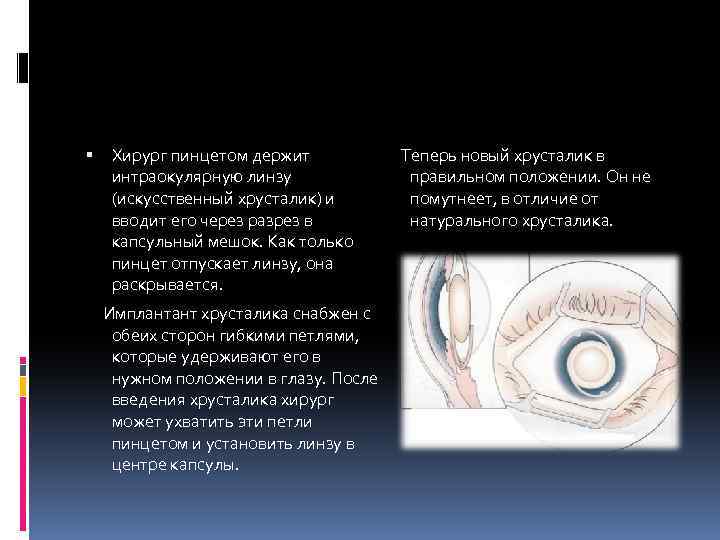  Хирург пинцетом держит интраокулярную линзу (искусственный хрусталик) и вводит его через разрез в
