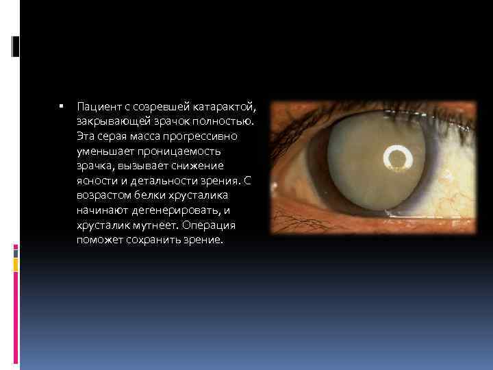  Пациент с созревшей катарактой, закрывающей зрачок полностью. Эта серая масса прогрессивно уменьшает проницаемость