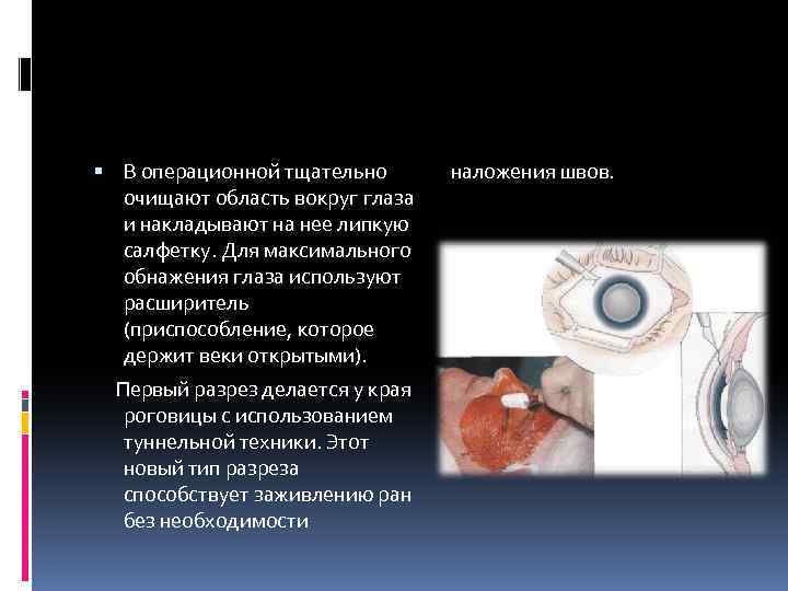  В операционной тщательно очищают область вокруг глаза и накладывают на нее липкую салфетку.