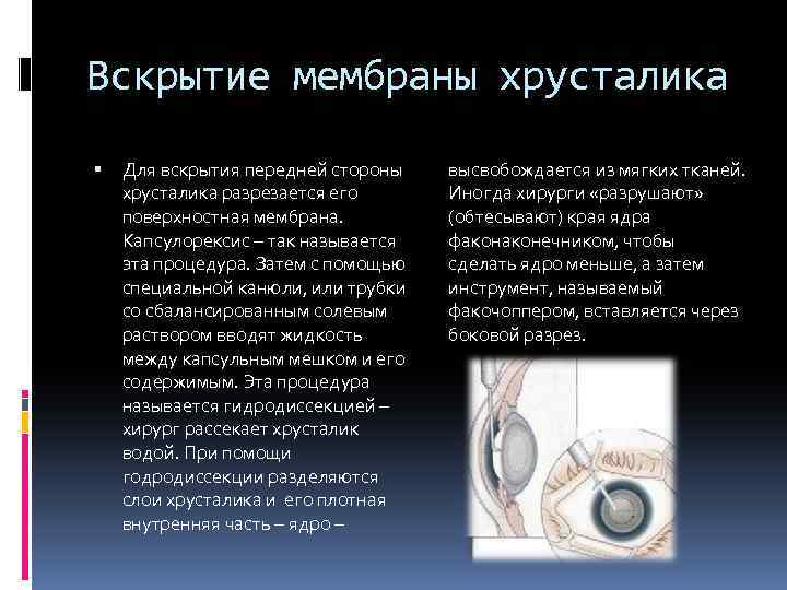 Вскрытие мембраны хрусталика Для вскрытия передней стороны хрусталика разрезается его поверхностная мембрана. Капсулорексис –