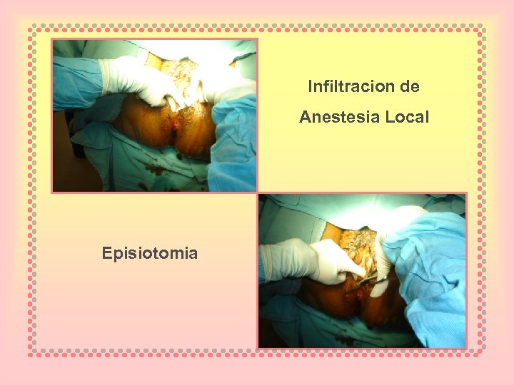 Infiltracion de Anestesia Local Episiotomia 