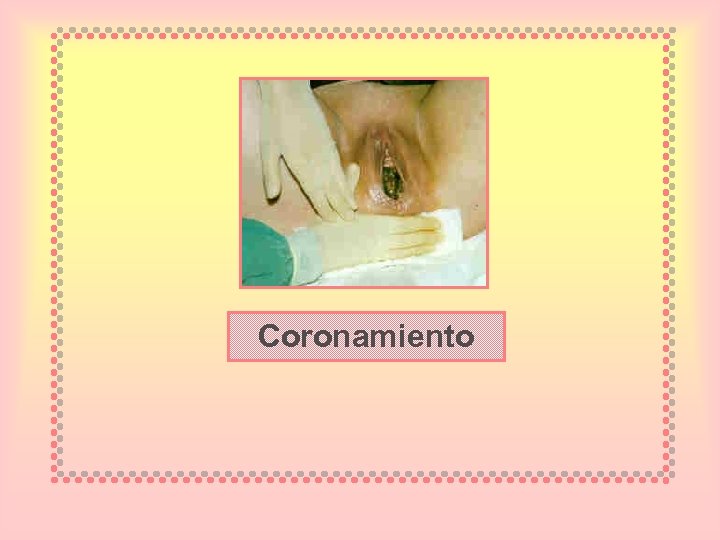 Coronamiento 