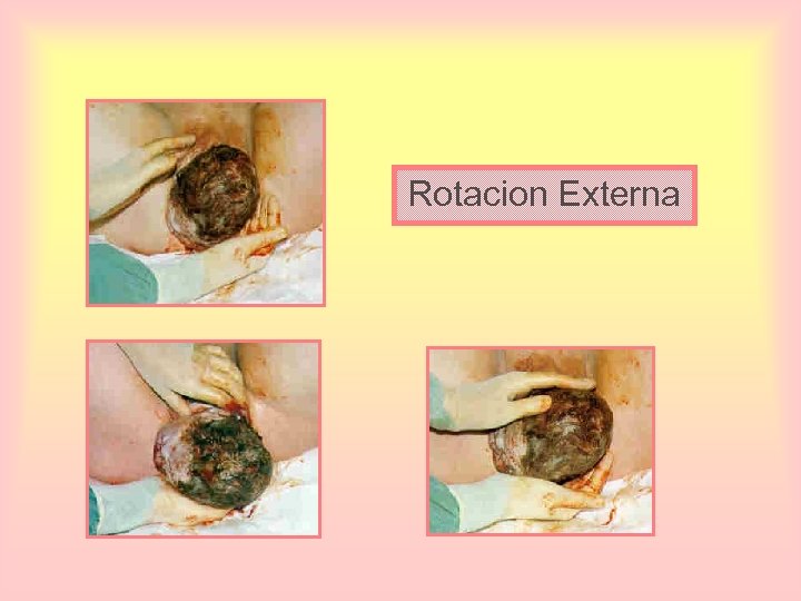 Rotacion Externa 