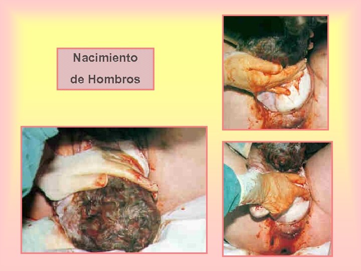 Nacimiento de Hombros 