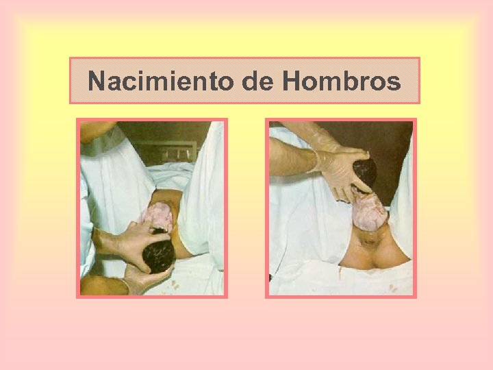 Nacimiento de Hombros 