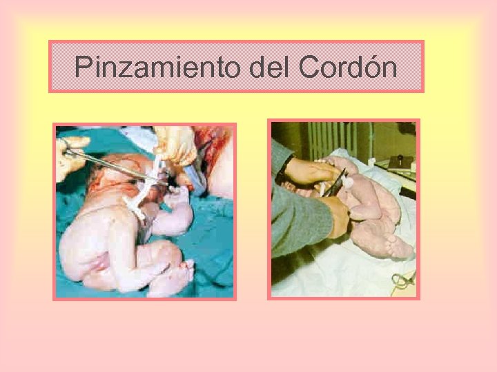 Pinzamiento del Cordón 