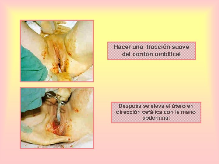 Hacer una tracción suave del cordón umbilical Después se eleva el útero en dirección