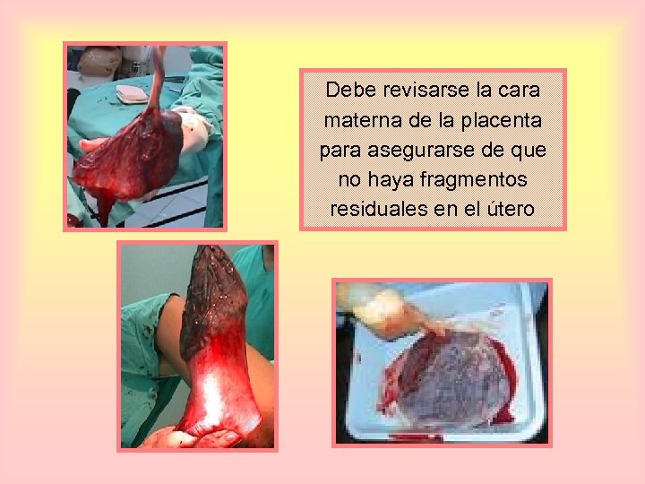 Debe revisarse la cara materna de la placenta para asegurarse de que no haya