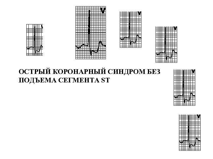 ОСТРЫЙ КОРОНАРНЫЙ СИНДРОМ БЕЗ ПОДЪЕМА СЕГМЕНТА ST 