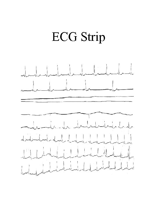 ECG Strip 