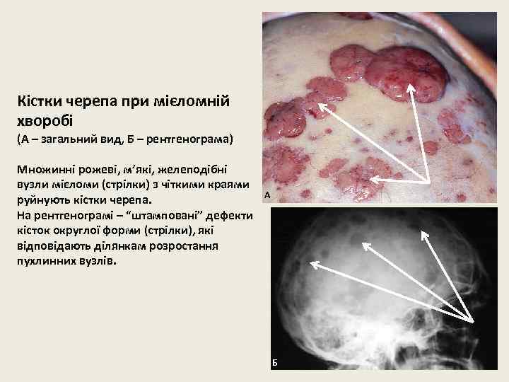 Кістки черепа при мієломній хворобі (А – загальний вид, Б – рентгенограма) Множинні рожеві,