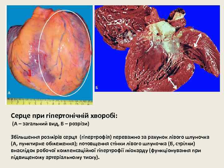 Б А Серце при гіпертонічній хворобі: (А – загальний вид, Б – розрізи) Збільшення