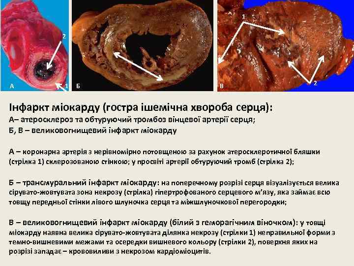 1 2 А 1 Б В 2 Інфаркт міокарду (гостра ішемічна хвороба серця): А–