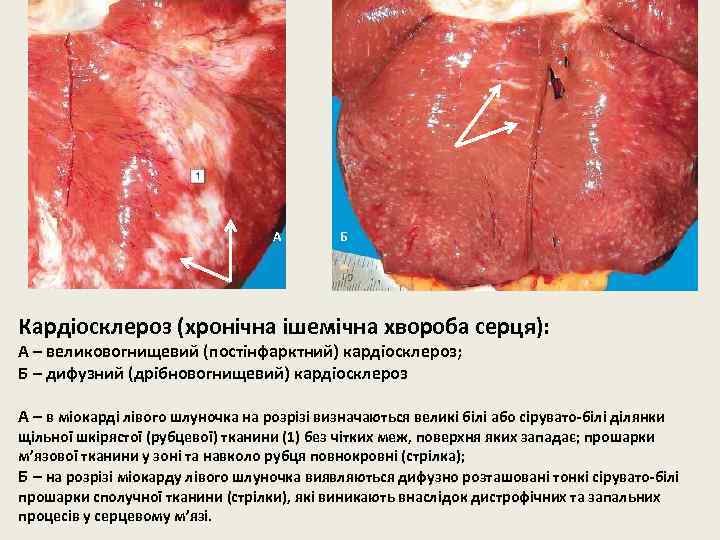 А Б Кардіосклероз (хронічна ішемічна хвороба серця): А – великовогнищевий (постінфарктний) кардіосклероз; Б –