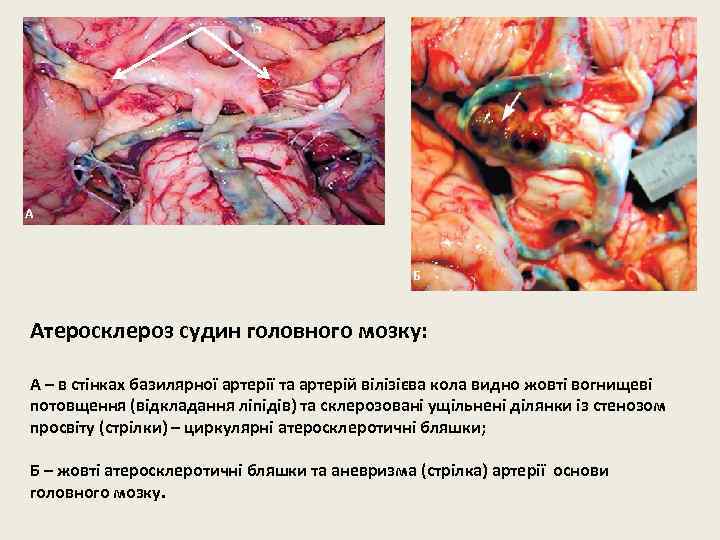 А Б Атеросклероз судин головного мозку: А – в стінках базилярної артерії та артерій