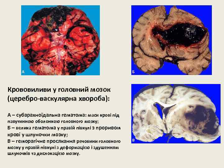 А Б Крововиливи у головний мозок (церебро-васкулярна хвороба): А – субарахноїдальна гематома: маси крові