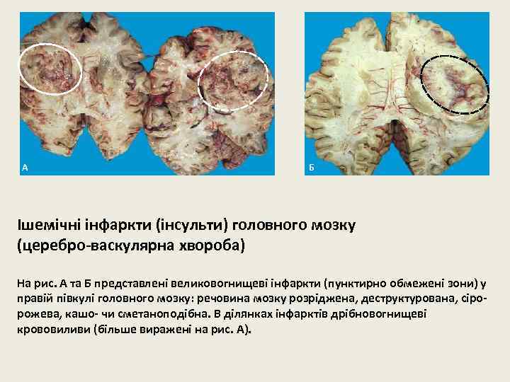 А Б Ішемічні інфаркти (інсульти) головного мозку (церебро-васкулярна хвороба) На рис. А та Б