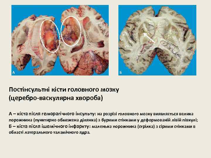 А Б Постінсультні кісти головного мозку (церебро-васкулярна хвороба) А – кіста після геморагічного інсульту: