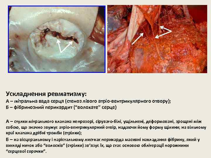 А Б Ускладнення ревматизму: А – мітральна вада серця (стеноз лівого атріо-вентрикулярного отвору); Б