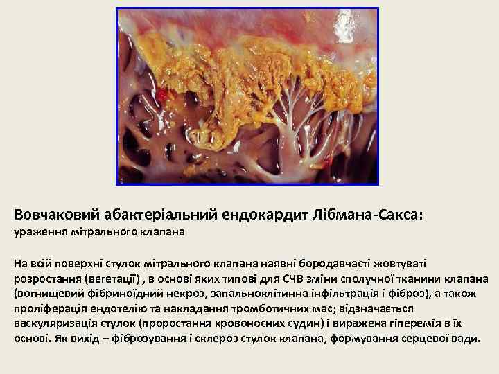 Вовчаковий абактеріальний ендокардит Лібмана-Сакса: ураження мітрального клапана На всій поверхні стулок мітрального клапана наявні