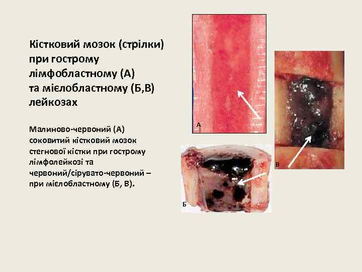 Кістковий мозок (стрілки) при гострому лімфобластному (А) та мієлобластному (Б, В) лейкозах А Малиново-червоний