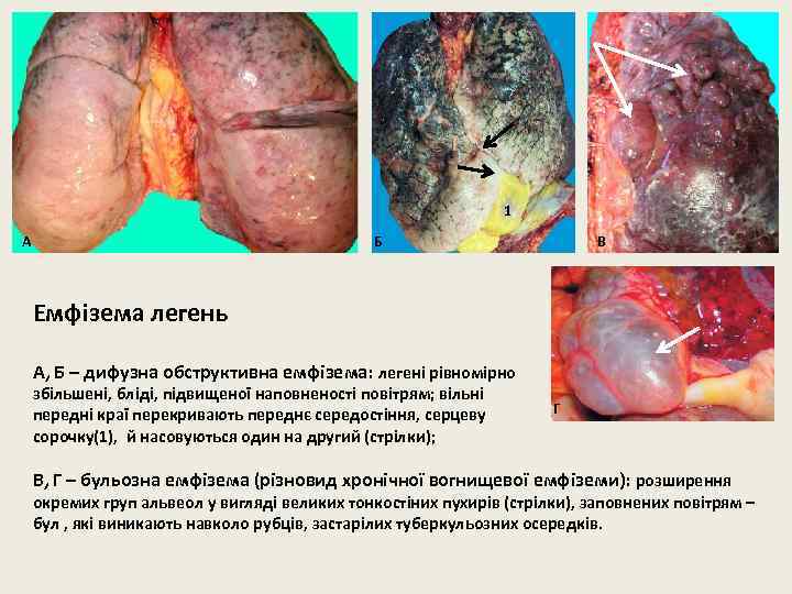 1 А Б В Емфізема легень А, Б – дифузна обструктивна емфізема: легені рівномірно