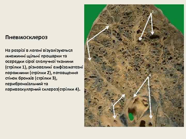 2 Пневмосклероз 1 На розрізі в легені візуалізуються множинні щільні прошарки та осередки сірої