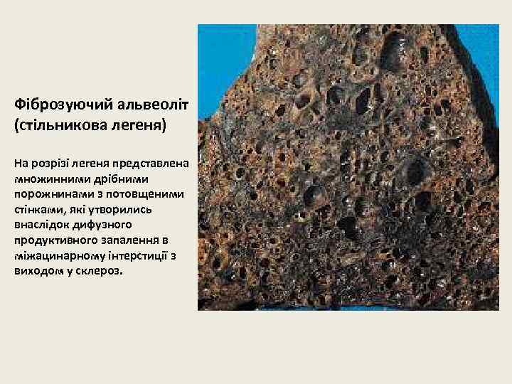 Фіброзуючий альвеоліт (стільникова легеня) На розрізі легеня представлена множинними дрібними порожнинами з потовщеними стінками,