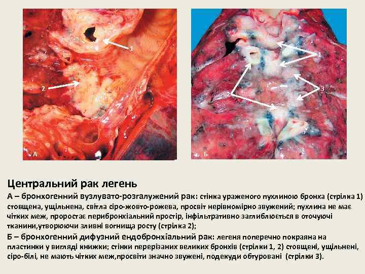 1 1 2 А 2 3 Б Центральний рак легень А – бронхогенний вузлувато-розгалужений