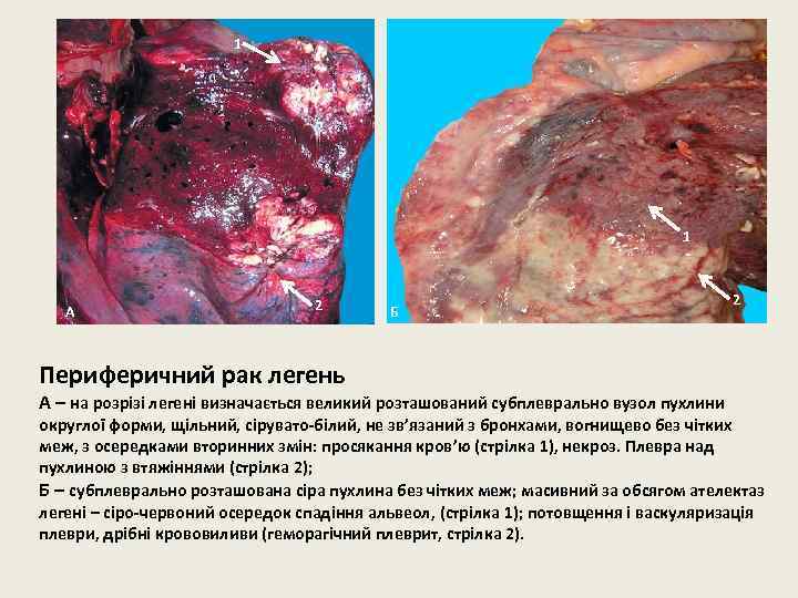1 1 А 2 Б 2 Периферичний рак легень А – на розрізі легені