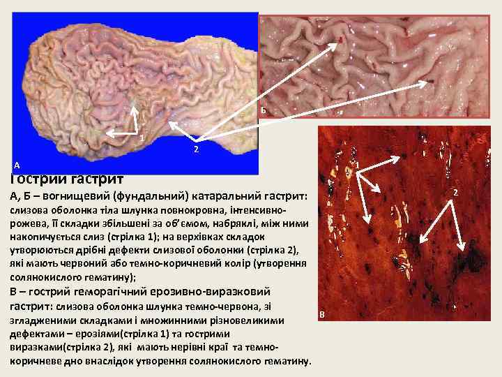 Б 1 2 А 1 Гострий гастрит 2 А, Б – вогнищевий (фундальний) катаральний