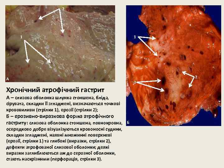 2 1 1 А 3 Хронічний атрофічний гастрит А – слизова оболонка шлунка стоншена,