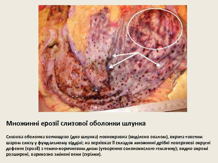Множинні ерозії слизової оболонки шлунка Слизова оболонка вогнищево (дно шлунка) повнокровна (виділено овалом), вкрита